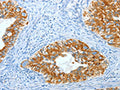 The image on the left is immunohistochemistry of paraffin-embedded Human cervical cancer tissue using CSB-PA696577(KRT40 Antibody) at dilution 1/30, on the right is treated with fusion protein. (Original magnification: ×200)