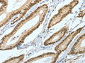 The image on the left is immunohistochemistry of paraffin-embedded Human colon cancer tissue using CSB-PA696621(ASH2L Antibody) at dilution 1/50, on the right is treated with fusion protein. (Original magnification: ×200)