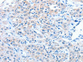 The image on the left is immunohistochemistry of paraffin-embedded Human lung cancer tissue using CSB-PA697138(ADAM7 Antibody) at dilution 1/30, on the right is treated with fusion protein. (Original magnification: ×200)