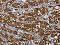 The image on the left is immunohistochemistry of paraffin-embedded Human breast cancer tissue using CSB-PA697513(PIP Antibody) at dilution 1/50, on the right is treated with fusion protein. (Original magnification: ×200)