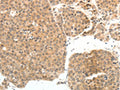 The image on the left is immunohistochemistry of paraffin-embedded Human ovarian cancer tissue using CSB-PA697643(PSMD7 Antibody) at dilution 1/20, on the right is treated with fusion protein. (Original magnification: ×200)