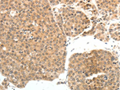 The image on the left is immunohistochemistry of paraffin-embedded Human ovarian cancer tissue using CSB-PA697643(PSMD7 Antibody) at dilution 1/20, on the right is treated with fusion protein. (Original magnification: ×200)