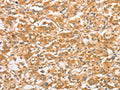 The image on the left is immunohistochemistry of paraffin-embedded Human thyroid cancer tissue using CSB-PA697913(TLR3 Antibody) at dilution 1/50, on the right is treated with fusion protein. (Original magnification: ×200)