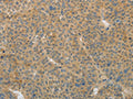 The image on the left is immunohistochemistry of paraffin-embedded Human liver cancer tissue using CSB-PA697937(TGFB1 Antibody) at dilution 1/25, on the right is treated with fusion protein. (Original magnification: X200)