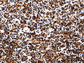 The image on the left is immunohistochemistry of paraffin-embedded Human tonsil tissue using CSB-PA698087(HP Antibody) at dilution 1/25, on the right is treated with fusion protein. (Original magnification: ×200)