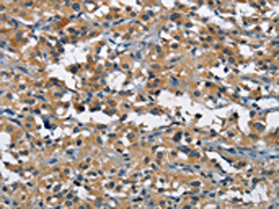 The image on the left is immunohistochemistry of paraffin-embedded Human thyroid cancer tissue using CSB-PA698112(BMPR1B Antibody) at dilution 1/25, on the right is treated with fusion protein. (Original magnification: ×200)