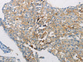 The image on the left is immunohistochemistry of paraffin-embedded Human breast cancer tissue using CSB-PA698191(AATK Antibody) at dilution 1/10, on the right is treated with synthetic peptide. (Original magnification: ×200)