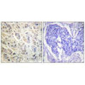 Immunohistochemistry analysis of paraffin-embedded human colon carcinoma tissue using p90 RSK (Ab-573) antibody.