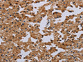 The image on the left is immunohistochemistry of paraffin-embedded Human prostate cancer tissue using CSB-PA698625(IFRD1 Antibody) at dilution 1/40, on the right is treated with fusion protein. (Original magnification: ×200)