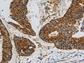 The image on the left is immunohistochemistry of paraffin-embedded Human colon cancer tissue using CSB-PA698741(CCNF Antibody) at dilution 1/20, on the right is treated with fusion protein. (Original magnification: ×200)