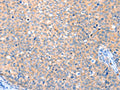 The image on the left is immunohistochemistry of paraffin-embedded Human cervical cancer tissue using CSB-PA698804(VANGL1 Antibody) at dilution 1/20, on the right is treated with fusion protein. (Original magnification: ×200)