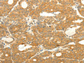 The image on the left is immunohistochemistry of paraffin-embedded Human thyroid cancer tissue using CSB-PA698932(SOX2 Antibody) at dilution 1/25, on the right is treated with fusion protein. (Original magnification: ×200)
