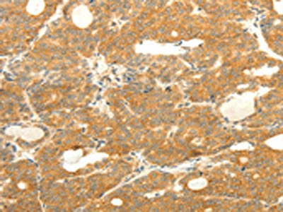The image on the left is immunohistochemistry of paraffin-embedded Human thyroid cancer tissue using CSB-PA698932(SOX2 Antibody) at dilution 1/25, on the right is treated with fusion protein. (Original magnification: ×200)