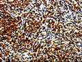The image is immunohistochemistry of paraffin-embedded Human lymphoma tissue using CSB-PA699319(STAT5B Antibody) at dilution 1/10. (Original magnification: ×200)