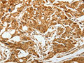 The image on the left is immunohistochemistry of paraffin-embedded Human lung cancer tissue using CSB-PA699479(TGFBR1 Antibody) at dilution 1/60, on the right is treated with synthetic peptide. (Original magnification: ×200)