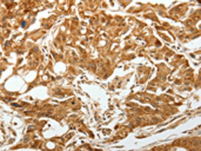 The image on the left is immunohistochemistry of paraffin-embedded Human lung cancer tissue using CSB-PA699479(TGFBR1 Antibody) at dilution 1/60, on the right is treated with synthetic peptide. (Original magnification: ×200)