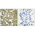 Immunohistochemical analysis of paraffin-embedded human breast carcinoma tissue using MMP-11 antibody.