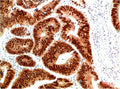 Immunohistochemical analysis of paraffin-embedded Human Colon Carcinoma Tissue using HSP40 Rabbit  pAb diluted at 1:200