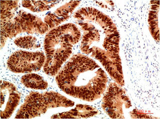Immunohistochemical analysis of paraffin-embedded Human Colon Carcinoma Tissue using HSP40 Rabbit  pAb diluted at 1:200