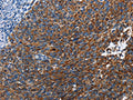 The image on the left is immunohistochemistry of paraffin-embedded Human cervical cancer tissue using CSB-PA703411(ETHE1 Antibody) at dilution 1/20, on the right is treated with fusion protein. (Original magnification: ×200)