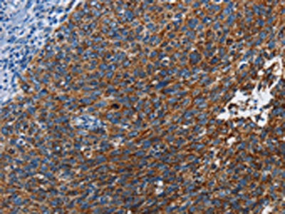 The image on the left is immunohistochemistry of paraffin-embedded Human cervical cancer tissue using CSB-PA703411(ETHE1 Antibody) at dilution 1/20, on the right is treated with fusion protein. (Original magnification: ×200)