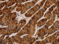 The image on the left is immunohistochemistry of paraffin-embedded Human liver cancer tissue using CSB-PA703502(IL17RA Antibody) at dilution 1/40, on the right is treated with synthetic peptide. (Original magnification: ×200)