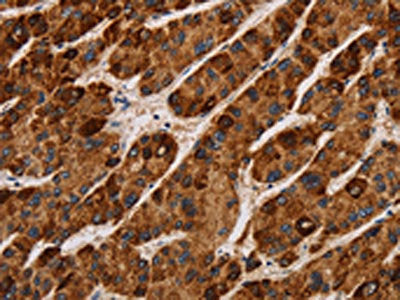 The image on the left is immunohistochemistry of paraffin-embedded Human liver cancer tissue using CSB-PA703502(IL17RA Antibody) at dilution 1/40, on the right is treated with synthetic peptide. (Original magnification: ×200)