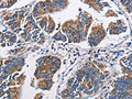 The image on the left is immunohistochemistry of paraffin-embedded Human colon cancer tissue using CSB-PA704716(NPPA Antibody) at dilution 1/60, on the right is treated with fusion protein. (Original magnification: ×200)