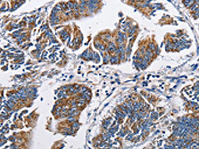 The image on the left is immunohistochemistry of paraffin-embedded Human colon cancer tissue using CSB-PA704716(NPPA Antibody) at dilution 1/60, on the right is treated with fusion protein. (Original magnification: ×200)