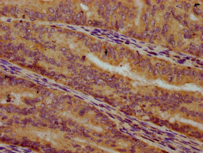 IHC image of CSB-PA704720LA01HU diluted at 1:300 and staining in paraffin-embedded human endometrial cancer performed on a Leica BondTM system. After dewaxing and hydration, antigen retrieval was mediated by high pressure in a citrate buffer (pH 6.0). Section was blocked with 10% normal goat serum 30min at RT. Then primary antibody (1% BSA) was incubated at 4&deg;C overnight. The primary is detected by a biotinylated secondary antibody and visualized using an HRP conjugated SP system.