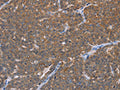 The image on the left is immunohistochemistry of paraffin-embedded Human ovarian cancer tissue using CSB-PA706521(FABP6 Antibody) at dilution 1/30, on the right is treated with fusion protein. (Original magnification: ×200)