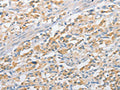 The image on the left is immunohistochemistry of paraffin-embedded Human thyroid cancer tissue using CSB-PA706929(APPBP2 Antibody) at dilution 1/25, on the right is treated with fusion protein. (Original magnification: ×200)