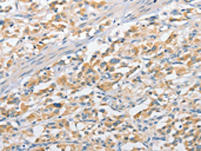 The image on the left is immunohistochemistry of paraffin-embedded Human thyroid cancer tissue using CSB-PA706929(APPBP2 Antibody) at dilution 1/25, on the right is treated with fusion protein. (Original magnification: ×200)