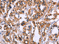 The image on the left is immunohistochemistry of paraffin-embedded Human thyroid cancer tissue using CSB-PA708659(ZEB2 Antibody) at dilution 1/60, on the right is treated with fusion protein. (Original magnification: ×200)