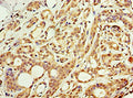 Immunohistochemistry of paraffin-embedded human breast cancer using CSB-PA709601ESR1HU at dilution of 1:100