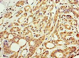 Immunohistochemistry of paraffin-embedded human breast cancer using CSB-PA709601ESR1HU at dilution of 1:100