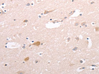 The image on the left is immunohistochemistry of paraffin-embedded Human brain tissue using CSB-PA715372(CIDEB Antibody) at dilution 1/50, on the right is treated with fusion protein. (Original magnification: ×200)