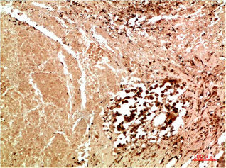 Immunohistochemical analysis of paraffin-embedded Human Lung Carcinoma Tissue using JNK3 Rabbit  pAb diluted at 1:200