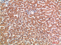 Immunohistochemical analysis of paraffin-embedded human-liver-cancer, antibody was diluted at 1:200