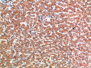 Immunohistochemical analysis of paraffin-embedded human-liver-cancer, antibody was diluted at 1:200