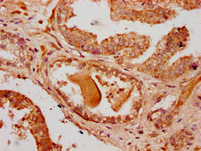IHC image of CSB-PA719619LA01HU diluted at 1:500 and staining in paraffin-embedded human prostate cancer performed on a Leica BondTM system. After dewaxing and hydration, antigen retrieval was mediated by high pressure in a citrate buffer (pH 6.0). Section was blocked with 10% normal goat serum 30min at RT. Then primary antibody (1% BSA) was incubated at 4&deg;C overnight. The primary is detected by a biotinylated secondary antibody and visualized using an HRP conjugated SP system.