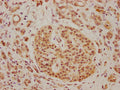 IHC image of CSB-PA721207LA01HU diluted at 1:100 and staining in paraffin-embedded human pancreatic cancer performed on a Leica BondTM system. After dewaxing and hydration, antigen retrieval was mediated by high pressure in a citrate buffer (pH 6.0). Section was blocked with 10% normal goat serum 30min at RT. Then primary antibody (1% BSA) was incubated at 4°C overnight. The primary is detected by a biotinylated secondary antibody and visualized using an HRP conjugated SP system.
