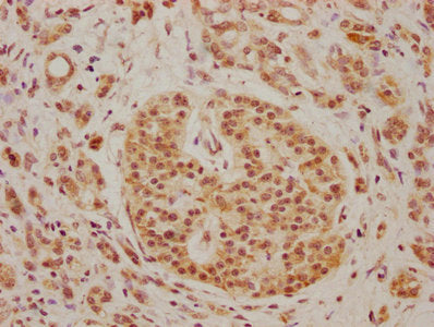 IHC image of CSB-PA721207LA01HU diluted at 1:100 and staining in paraffin-embedded human pancreatic cancer performed on a Leica BondTM system. After dewaxing and hydration, antigen retrieval was mediated by high pressure in a citrate buffer (pH 6.0). Section was blocked with 10% normal goat serum 30min at RT. Then primary antibody (1% BSA) was incubated at 4°C overnight. The primary is detected by a biotinylated secondary antibody and visualized using an HRP conjugated SP system.