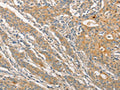 The image on the left is immunohistochemistry of paraffin-embedded Human gastic cancer tissue using CSB-PA724791(STAM Antibody) at dilution 1/40, on the right is treated with fusion protein. (Original magnification: ×200)