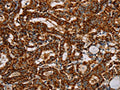 The image on the left is immunohistochemistry of paraffin-embedded Human thyroid cancer tissue using CSB-PA725678(NDUFS3 Antibody) at dilution 1/40, on the right is treated with fusion protein. (Original magnification: ×200)