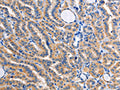 The image on the left is immunohistochemistry of paraffin-embedded Human thyroid cancer tissue using CSB-PA725690(ALG8 Antibody) at dilution 1/30, on the right is treated with fusion protein. (Original magnification: ×200)