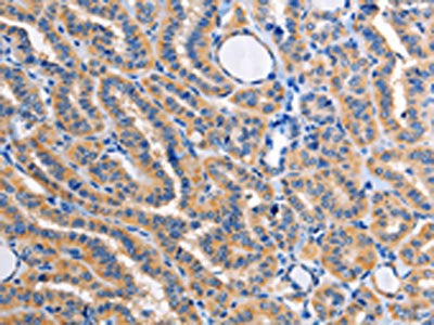 The image on the left is immunohistochemistry of paraffin-embedded Human thyroid cancer tissue using CSB-PA725690(ALG8 Antibody) at dilution 1/30, on the right is treated with fusion protein. (Original magnification: ×200)