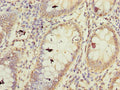 Immunohistochemistry of paraffin-embedded human colon cancer using CSB-PA726395LA01HU at dilution of 1:100