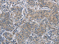The image on the left is immunohistochemistry of paraffin-embedded Human gastric cancer tissue using CSB-PA727123(DNAJB4 Antibody) at dilution 1/50, on the right is treated with fusion protein. (Original magnification: ×200)