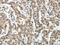 The image on the left is immunohistochemistry of paraffin-embedded Human breast cancer tissue using CSB-PA727952(IL1R1 Antibody) at dilution 1/25, on the right is treated with fusion protein. (Original magnification: ×200)